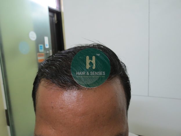 Hair Transplant Case Study